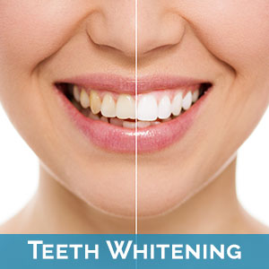 Teeth Whitening Bloomingdale